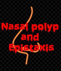 Nasal polyp and Epistaxis 