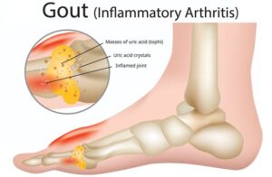 GOUT - Inflammatory arthritis