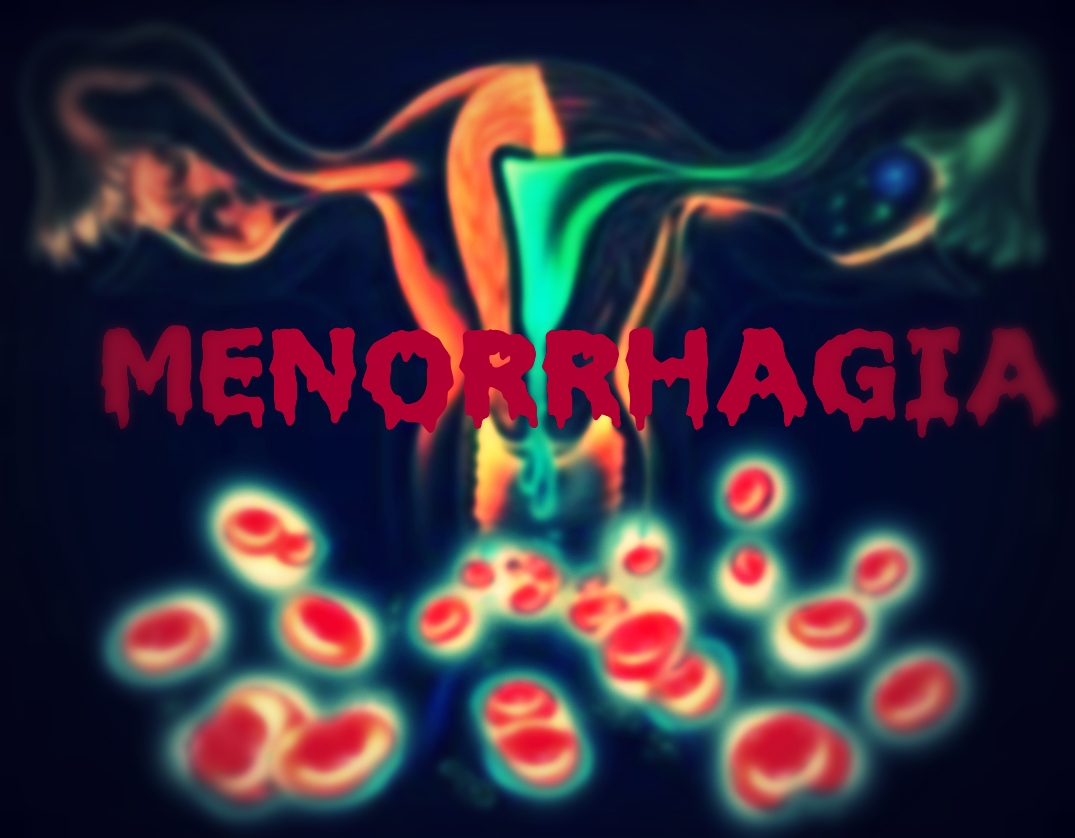 Menorrhagia causes and its Homoeopathic management – HDS