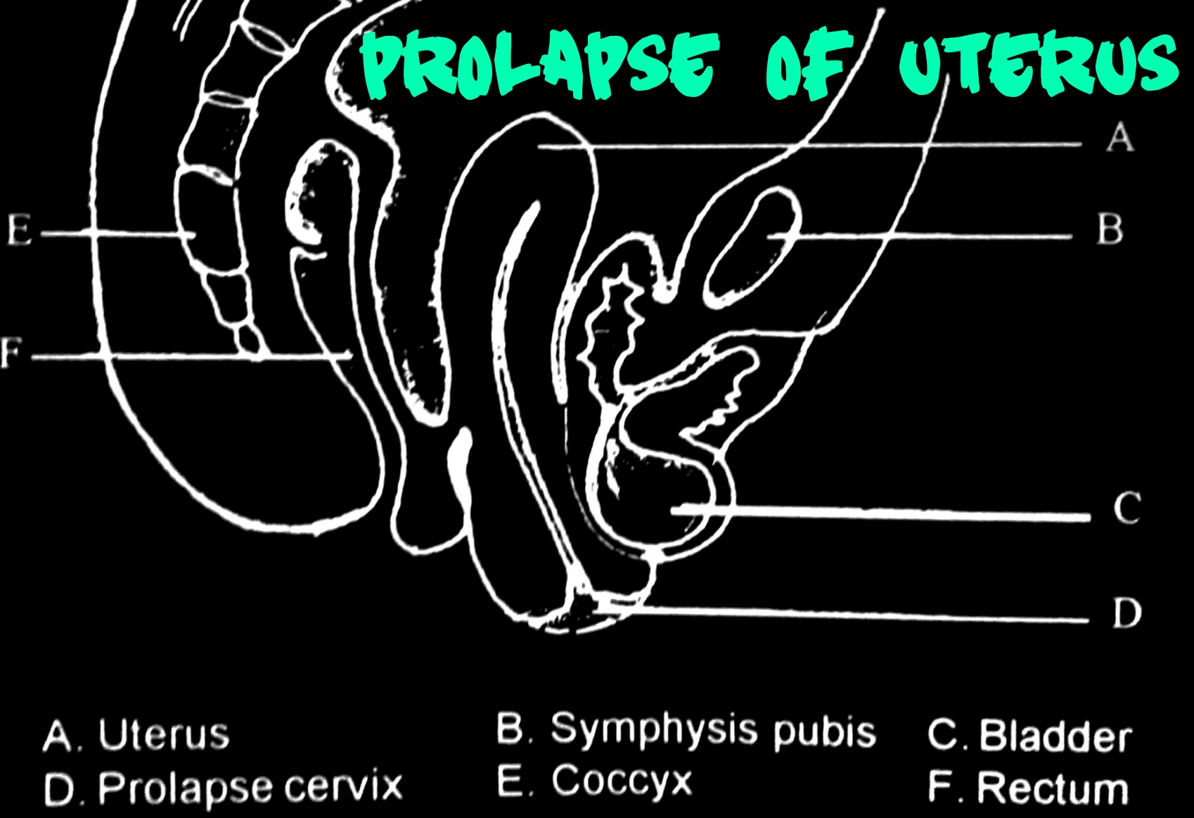 Prolapse of uterus with Homeopathy