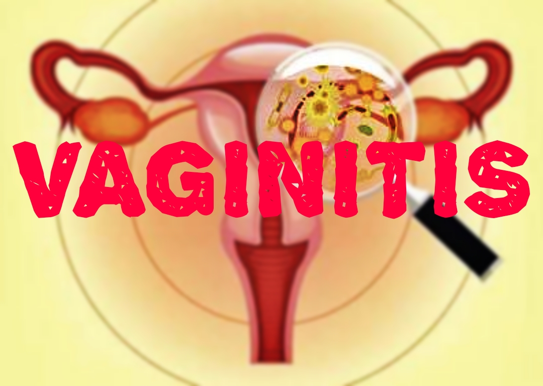 Acute Vaginitis Introdution with Homeopathic management