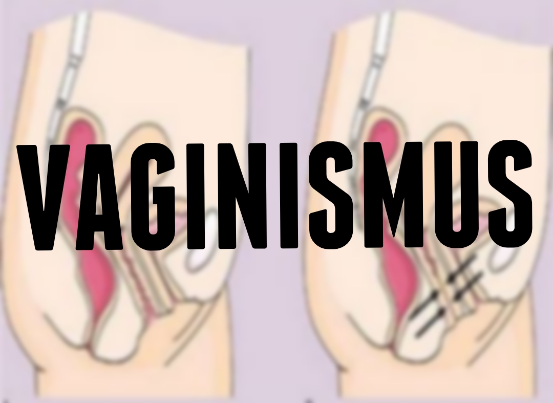 Vaginismus Introduction with Homeopathic Management