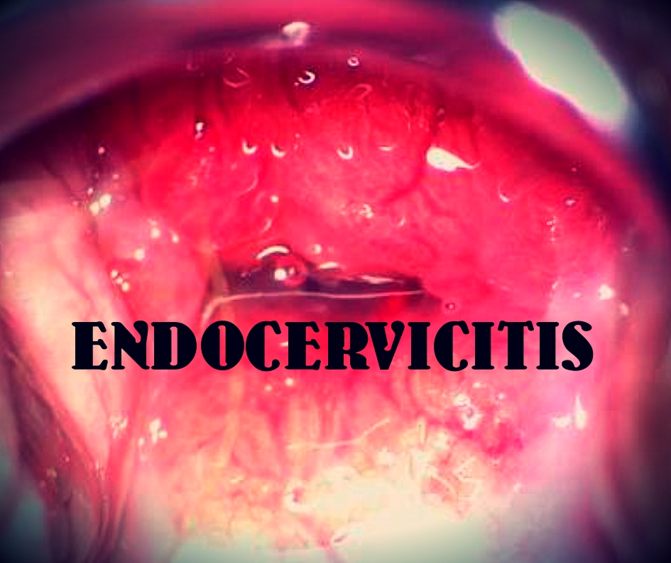 Endocervicitis Introduction with Homeopathic management