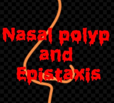 Nasal polyp and Epistaxis