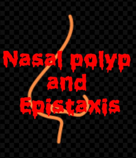 Nasal polyp and Epistaxis