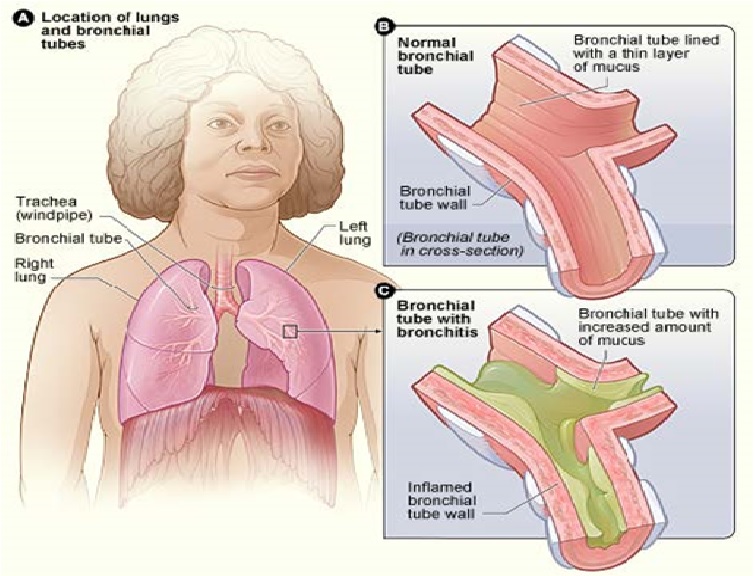 Chronic Bronchitis with Homoeopathic management | HDS