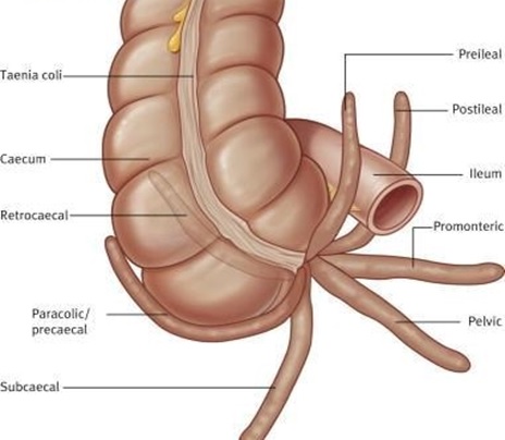 Appendicitis with Homoeopathy management | HDS