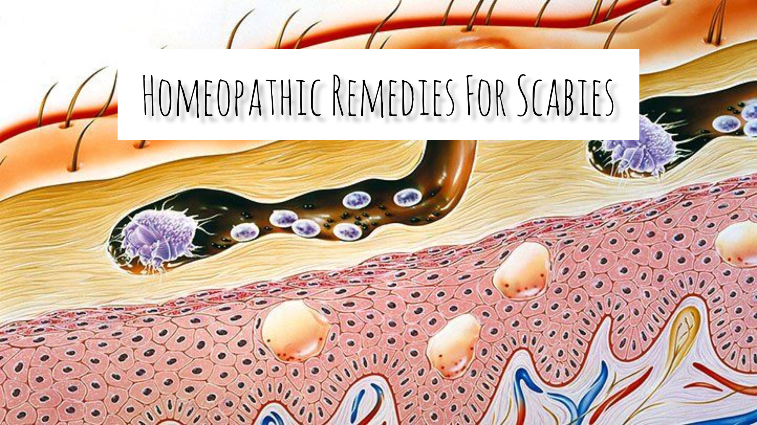 Homeopathic Remedies For Scabies | Clinical Tips | HDS