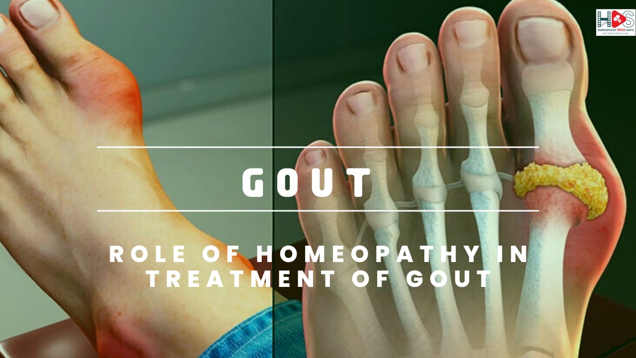 GOUT | Role of Homoeopathic Remedies in Treatment of Gout | HDS