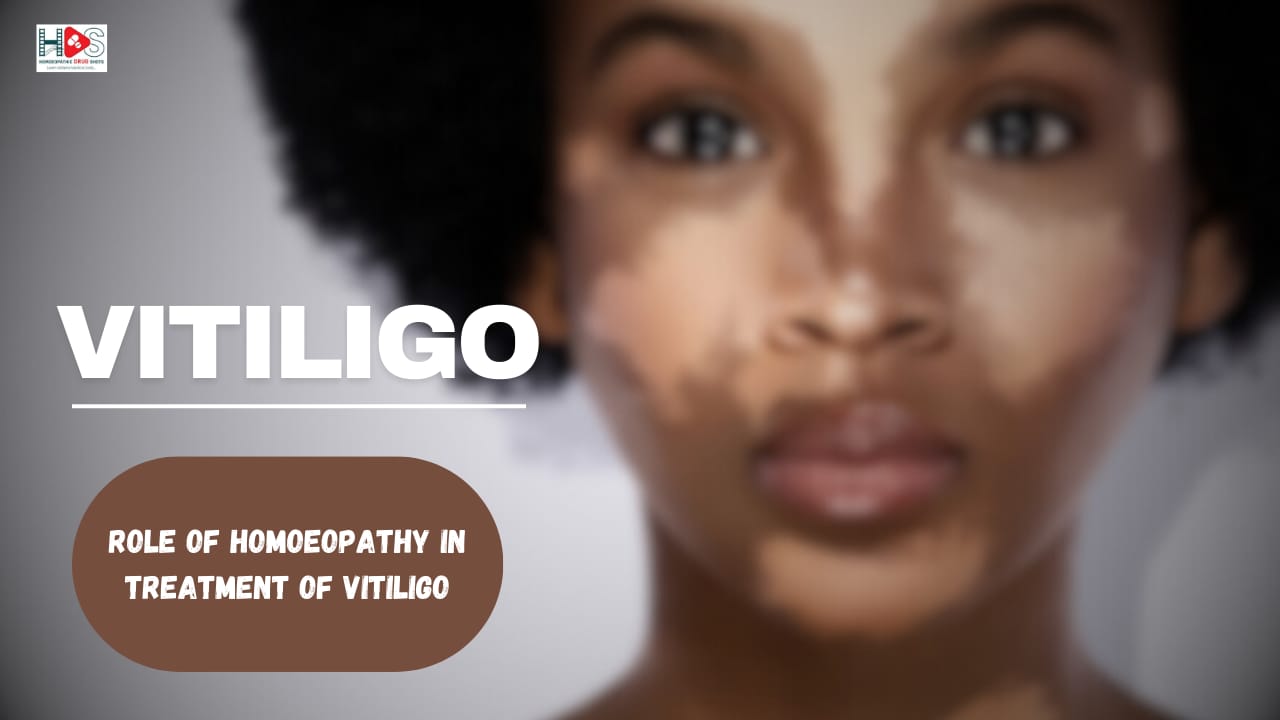 Vitiligo | Role of Homoeopathy in Treatment of Vitiligo | HDS